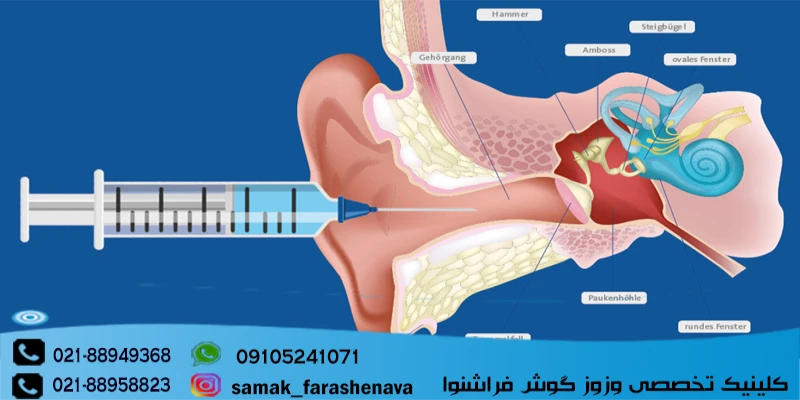 تزریق کورتون در گوش برای درمان وزوز گوش